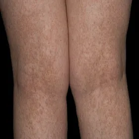 Wysypka skórna na nogach choroba Dariera