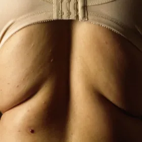 Wysypka skórna na plecach - choroba anetoderma