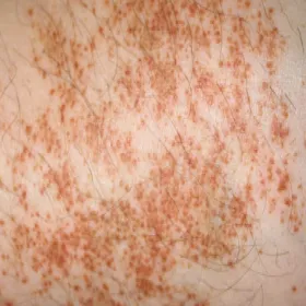 Wysypka u dorosłych choroba Schamberga