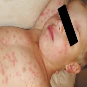 Wysypka u dziecka choroba odra