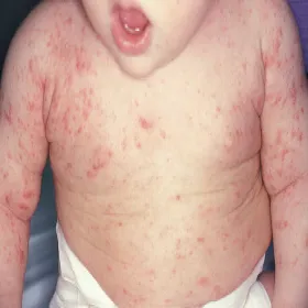 Wysypka u dziecka na skórze choroba świerzb