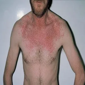 Wysypka u mężczyzn choroba Dariera