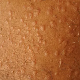 Wysypka w postaci grudek na skórze ziarniniak obrączkowaty 