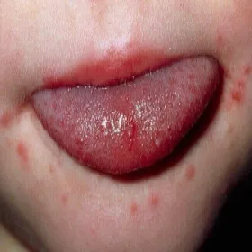 Wysypka wokół ust u dziecka 