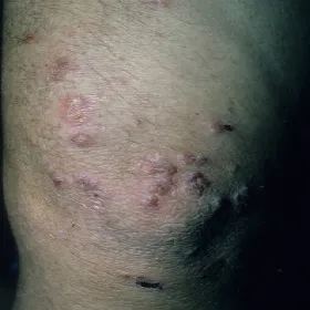 Wysypki na ciele o różnych rozmiarach i kształtach opryszczkowate zapalenie skóry