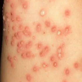 Wysypki pęcherzykowo-krostkowe liszajec 