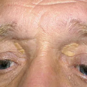 Xanthelasma 