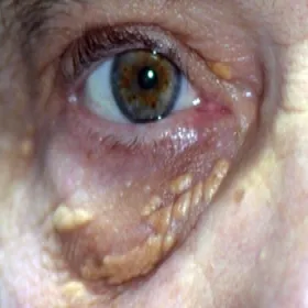 Złogi cholesterolowe pod oczami żółtaki 