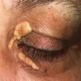 Złogi cholesterolowe pod oczami kępki żółte