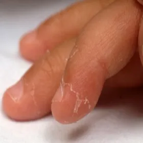  Złuszczanie się skóry choroba Kawasakiego