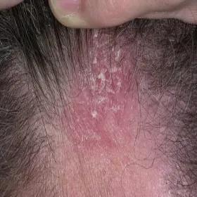 Złuszczanie się skóry i swędzenie głowy 