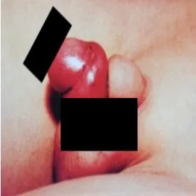 Załupek u niemowlaka