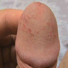 Zaczerwienienia, plamki, krostki na prąciu balanitis  