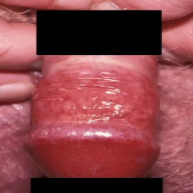 Zaczerwienienie napletka i swędzenie zapalenie napletka