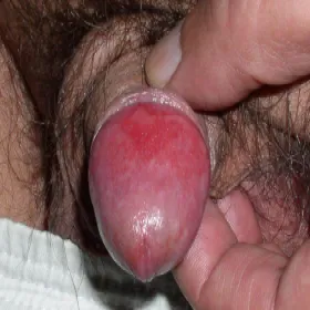 Zaczerwieniona żołądź balanitis  