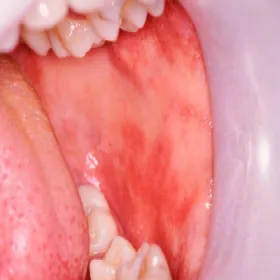 Zaczerwienione gardło u dzieci choroba odra