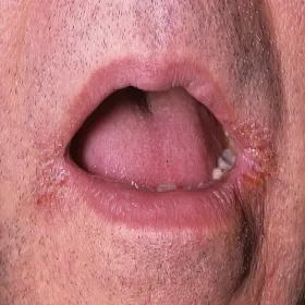 Zajady w kącikach ust