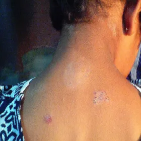 Zakażenia grzybicze u dziecka od świnki morskiej