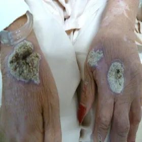 Zakażenie grzybicze sporotrychoza 