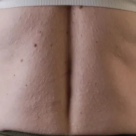 Zanik plamisty skóry forma guzów