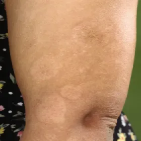 Zanik plamisty skóry 