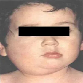 Zapalenie ślinianki podjęzykowej świnka