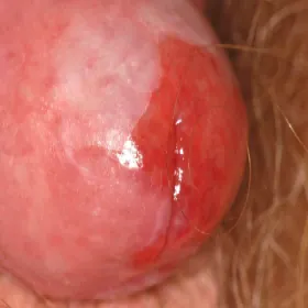 Zapalenie żołędzi Zoona