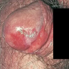 Zapalenie żołędzi erytroplazja Queyrata