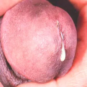 Zapalenie cewki moczowej u mężczyzny z wyraźną lub lekko mętną wydzieliną