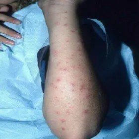 Zapalenie mieszków włosowych Pseudomonas aeruginosa