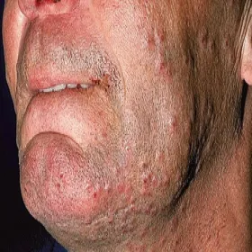 Zapalenie mieszków włosowych na brodzie