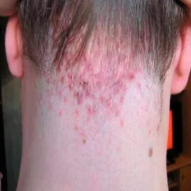 Zapalenie mieszków włosowych na karku szyi