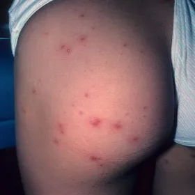 Zapalenie mieszków włosowych na pośladku