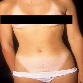 Zapalenie mieszków włosowych u kobiet