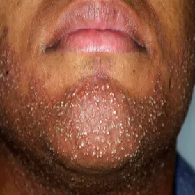 Zapalenie mieszków włosowych u mężczyzny twarz broda