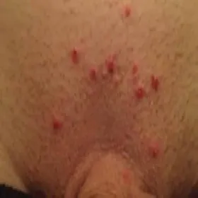 Zapalenie mieszka włosowego w miejscu intymnym u mężczyzny