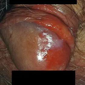 Zapalenie napletka erytroplazja Queyrata