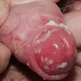 Zapalenie napletka wygląd