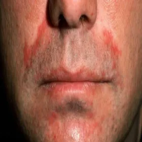 Zapalenie okołoustne u mężczyzn