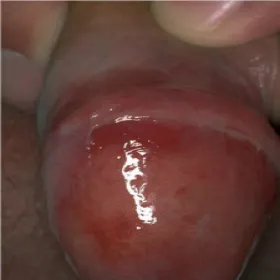 Zapalenie plazmakomórkowe żołędzi Zoon