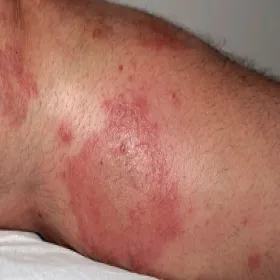 Zapalenie skóry choroba Duhringa