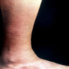 Zapalenie skóry pelagra