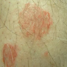 Zapalenie skóry wyprysk pieniążkowaty