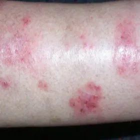 Zapalenie skóry wyprysk pieniążkowy