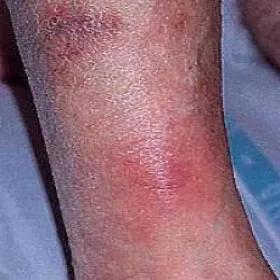 Zapalenie tkanki podskórnej jak wygląda