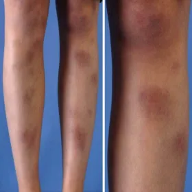 Zapalenie tkanki podskórnej 