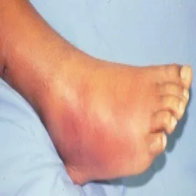 Zapalenie tkanki tłuszczowej na stopie