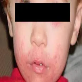 Zapalenie okołoustne u dzieci