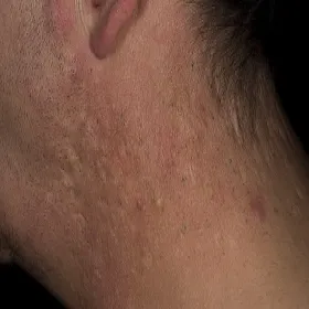 Zaskórniki otwarte broda szyja