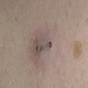 Zaskórniki otwarte na skórze